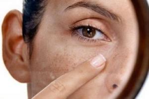 Как избавиться от пигментных пятен на лице, профилактика проблемы Почему пигментация на лице у женщин